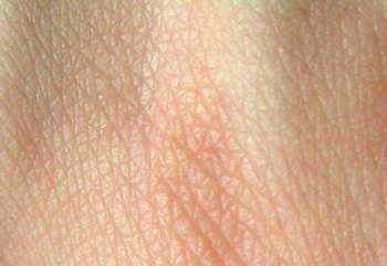 Human skin structure. Credit: Wikipedia