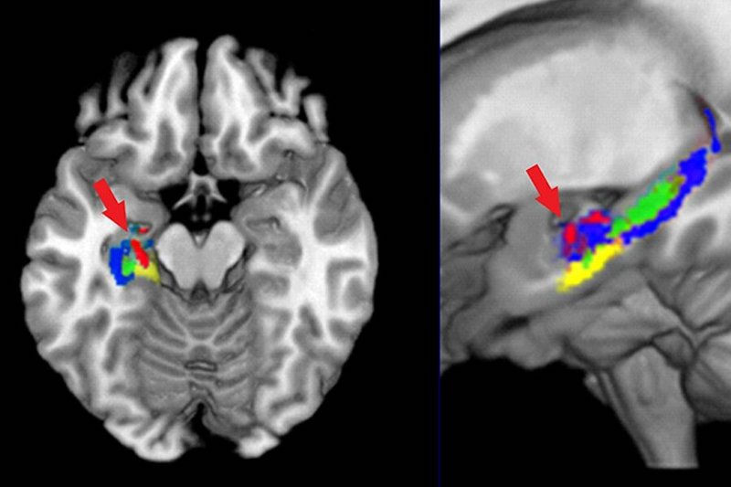The region of left hippocampus in red shows decreased mean diffusivity (MD) after learning. The following hippocampal subregions are shown: Cornu Ammonis (CA) in blue; dentate gyrus in green, and subiculum in yellow. Credit: Marcel Just and Timothy Keller